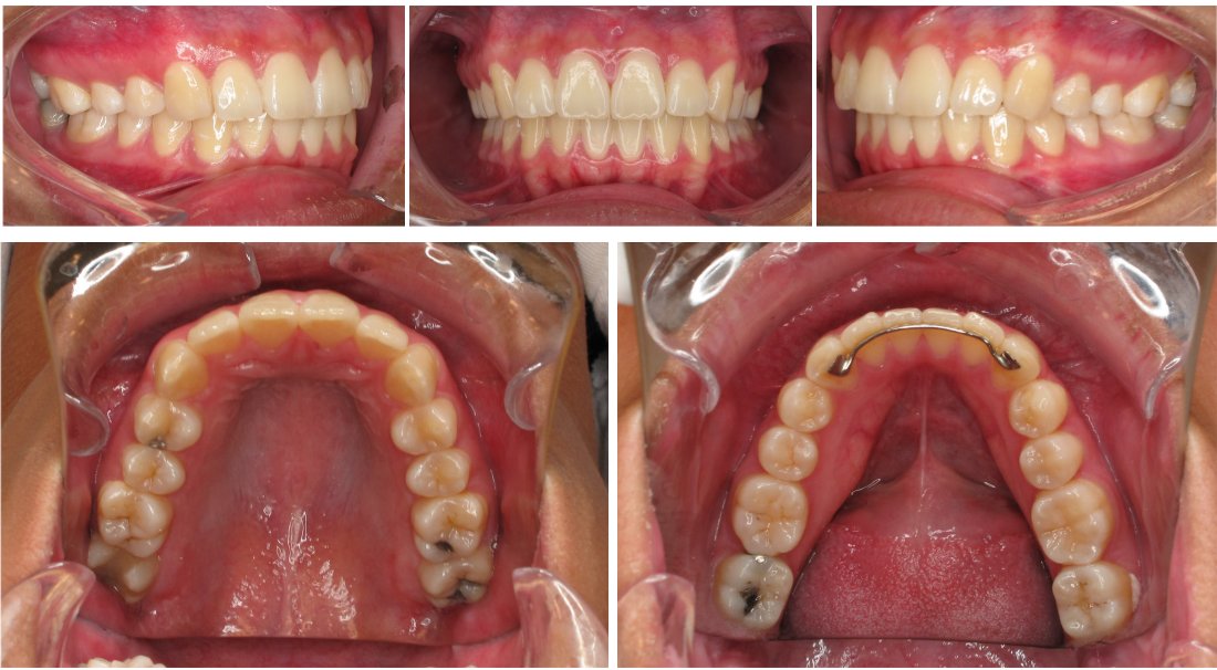 dental photography with iphone 13