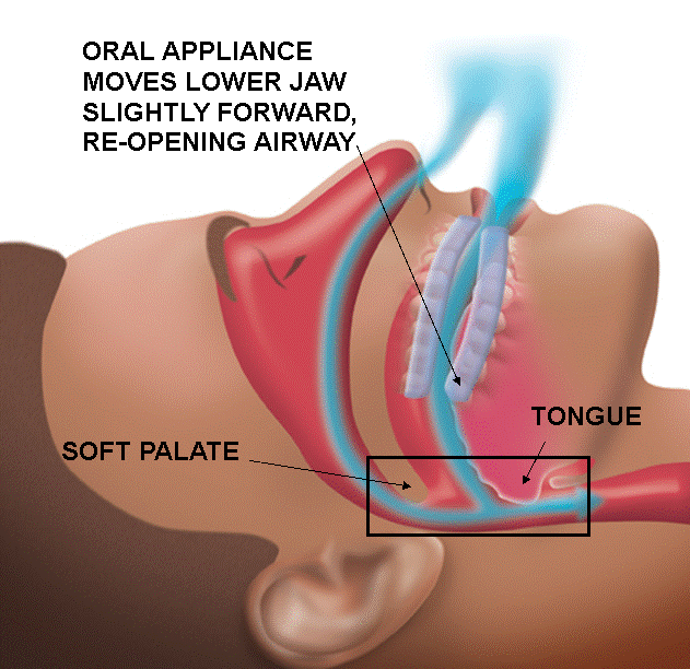 Sleep Apnea Appliance