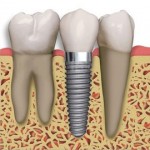 Dental implants Bakersfield, CA