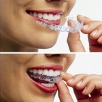 Dental_Invisalign Invisalign Dentist Bakersfield, CA