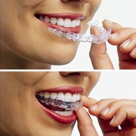 Invisalign Dentist Bakersfield, CA