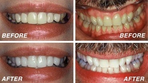 Teeth whitening Bakersfield, CA