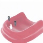 denture implants Bakersfield, CA