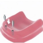 denture implants Bakersfield, CA