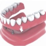 denture implants Bakersfield, CA SDDS Dental