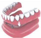 denture implants Bakersfield, CA SDDS Dental