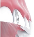 Front Tooth Implant Crown Bakersfield, CA