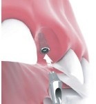 Front Tooth Implant Crown Bakersfield, CA SDDS Dental