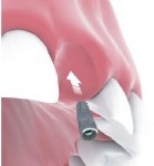 Front Tooth Implant Crown Bakersfield, CA