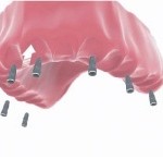 full mouth implants Bakersfield, CA