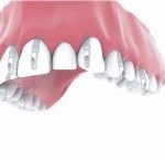 full mouth implants Bakersfield, CA