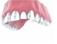 full mouth implants Bakersfield, CA