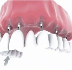 full mouth implants Bakersfield, CA SDDS Dental