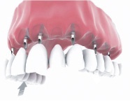 full mouth implants Bakersfield, CA SDDS Dental