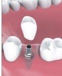 Single Tooth Implants Bakersfield, CA Dentist SDDS Dental Implant dentist