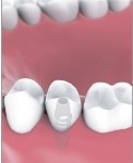 Single Tooth Implant Bakersfield, CA Dentist