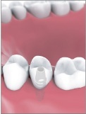 Single Tooth Implant Bakersfield, CA Dentist
