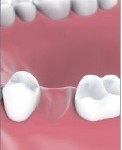 Single Tooth Implant Bakersfield, CA Dentist