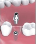 Single Tooth Implant Bakersfield, CA Dentist