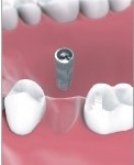 Single Tooth Implant Bakersfield, CA Dentist