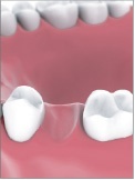 Single Tooth Implant Bakersfield, CA Dentist