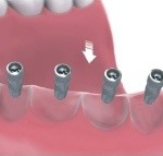 multiple teeth implants Bakersfield, CA