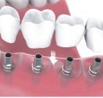 multiple teeth implants Bakersfield, CA SDDS Dental
