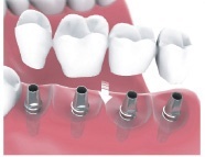 multiple teeth implants Bakersfield, CA SDDS Dental