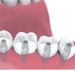 multiple teeth implants Bakersfield, CA
