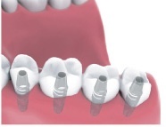 multiple teeth implants Bakersfield, CA