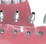 multiple teeth implants Bakersfield, CA