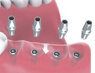 multiple teeth implants Bakersfield, CA