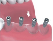 multiple teeth implants Bakersfield, CA