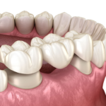 SDDS-Dental-Bridge