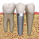 SDDS Dental Bakersfield Dental Implants Implants