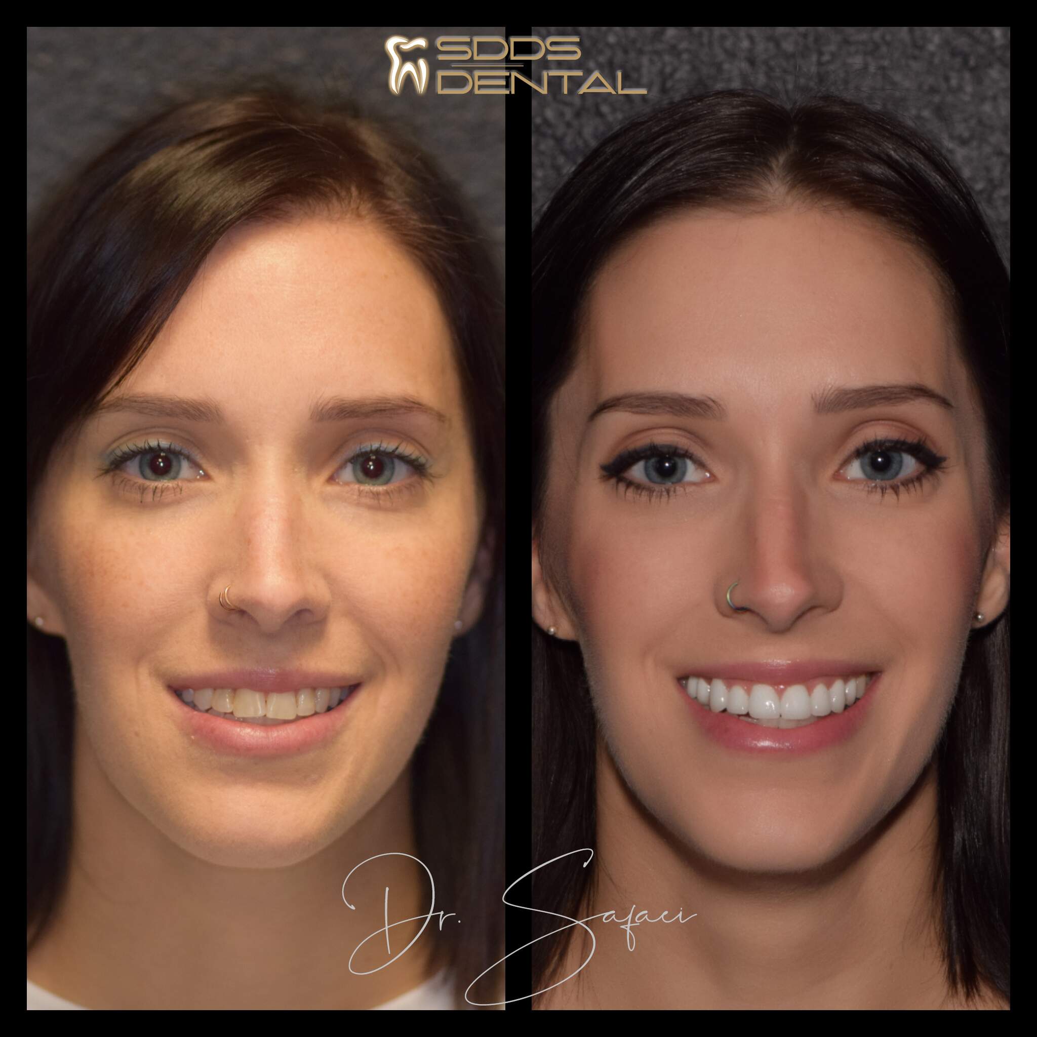 A women before & after dental treatment