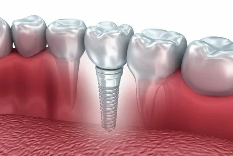 Dental Implanment