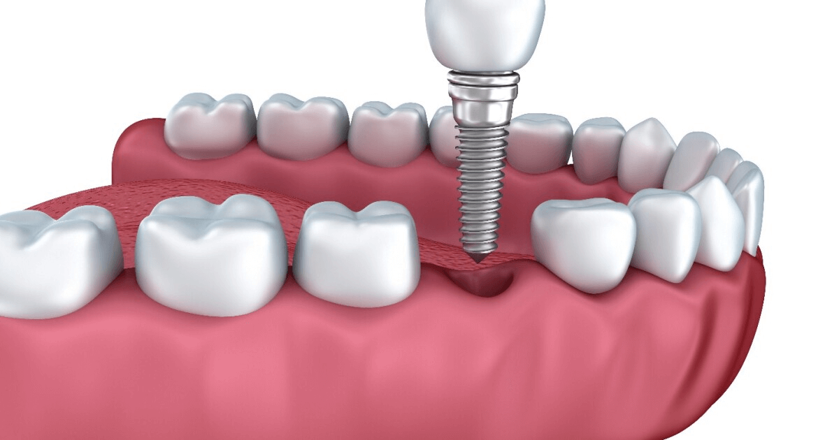 Dental Implant