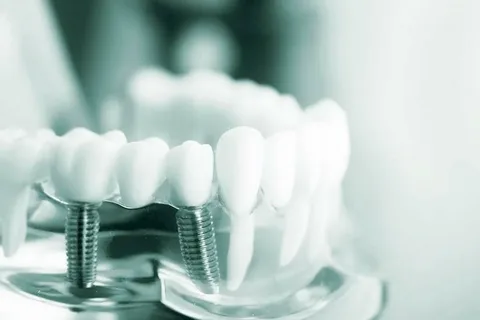 Dental Implant