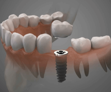 Dental Implants